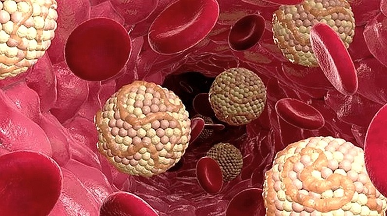Не допускайте ошибку при повышенном холестерине: это может привести к атеросклерозу