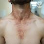 Московские врачи помогли мужчине, который решил самостоятельно вырвать борщевик, не используя защитную одежду, и получил обширные ожоги рук, шеи и тела