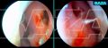 Москвичка прожгла себе дыру в носовой перегородке спреем от насморка