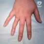 Москвичка едва не лишилась пальца из-за обручального кольца