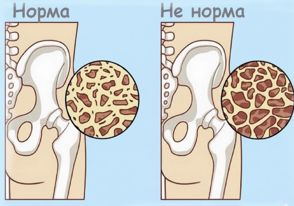 Как поддержать крепкие кости после 55: важные советы для активной жизни
