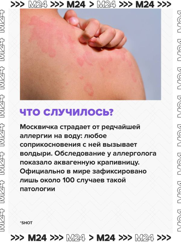 У москвички проявилась крайне редкая форма аллергии: кожа покрывается волдырями при любом контакте с водой У москвички проявилась крайне редкая форма аллергии: кожа покрывается волдырями при любом контакте с водой